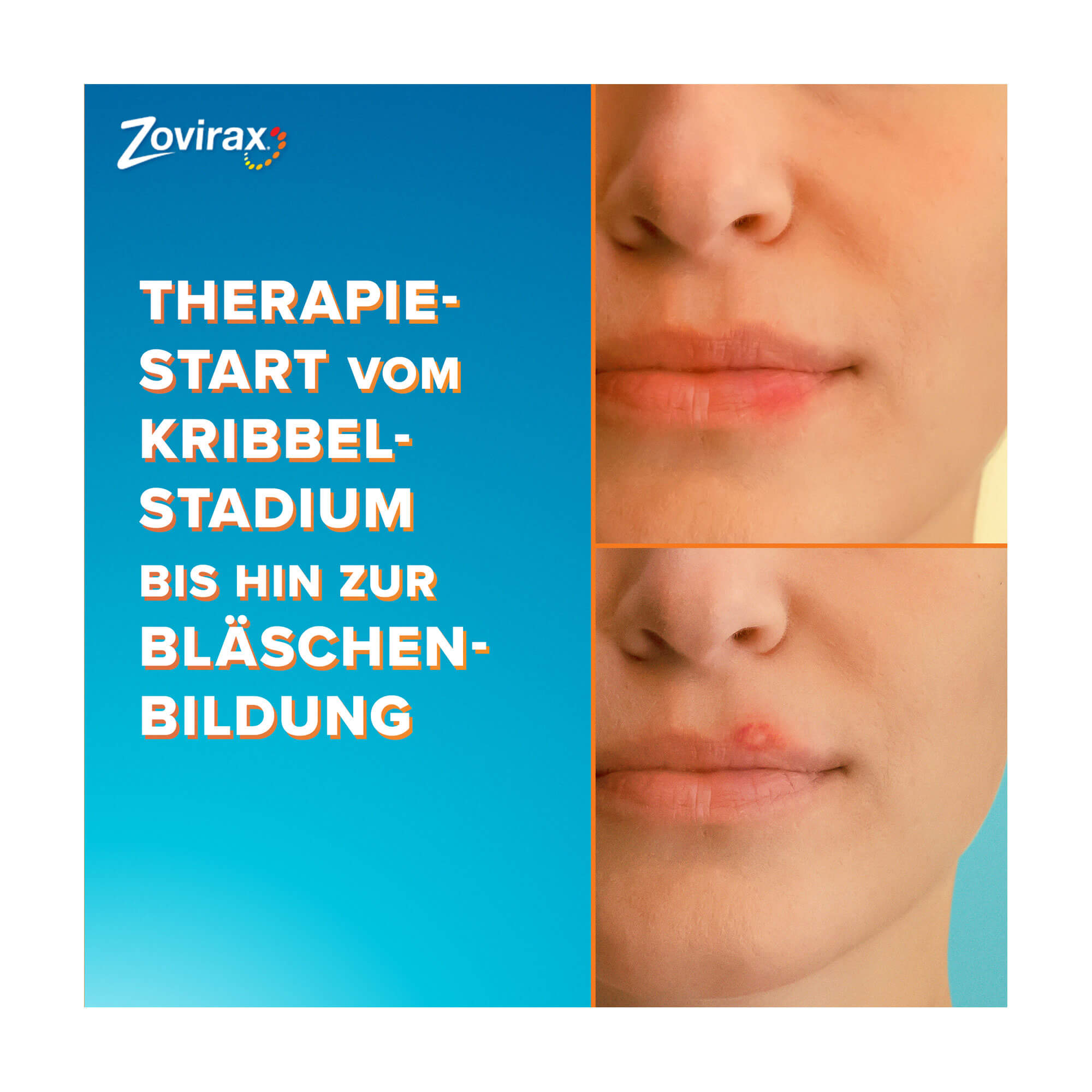 Grafik Zovirax Lippenherpescreme Therapiestart vom Kribbelstadium bis hin zur Bläschenbildung