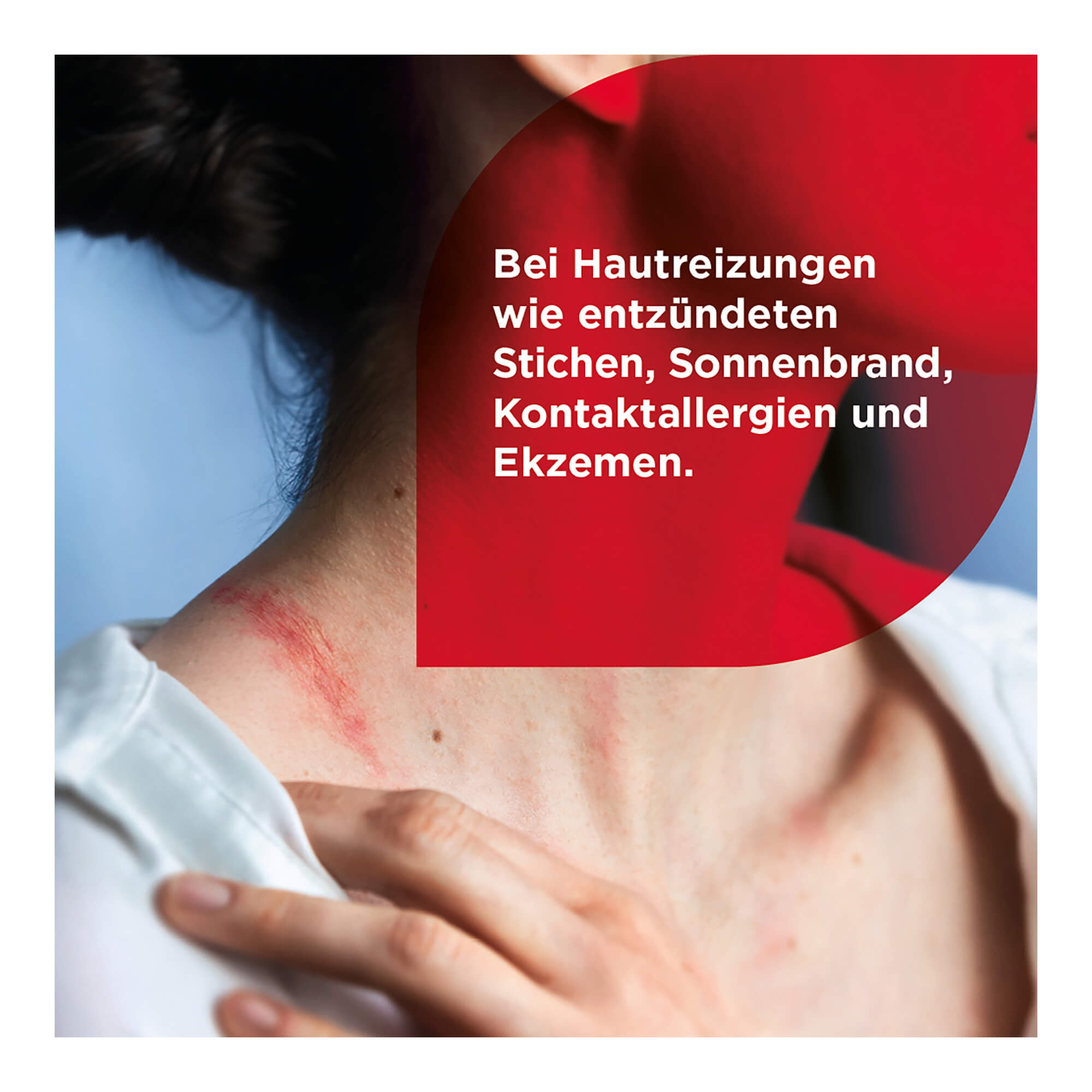 Grafik Soventol Hydrocortisonacetat 0,25 % Creme Bei Hautreizungen wie entzündeten Stichen, Sonnenbrand, Kontaktallergie und Ekzemen