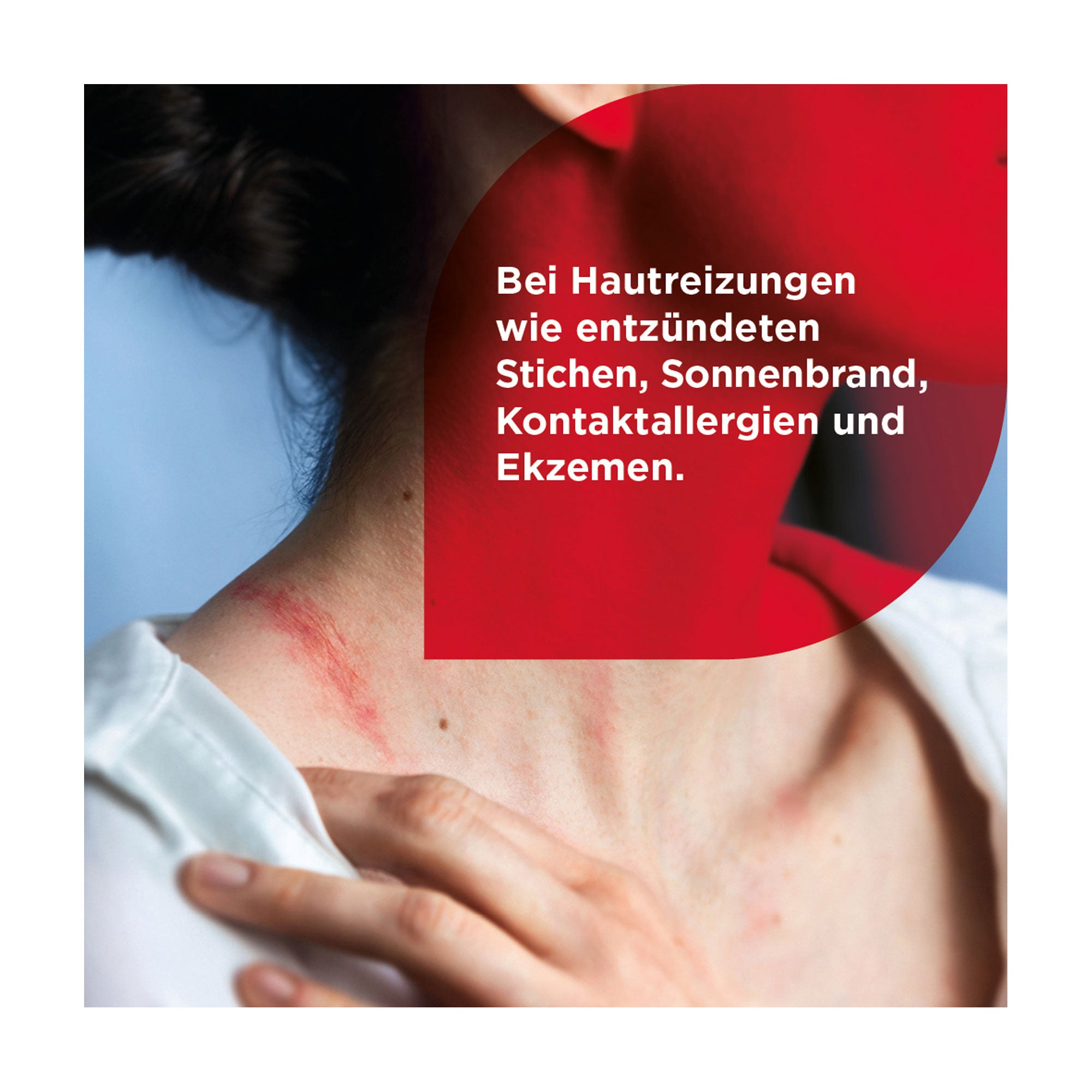 Grafik Soventol Hydrocortisonacetat 0,5 % Creme Bei Hautreizungen wie entzündeten Stichen, Sonnenbrand, Kontaktallergie und Ekzemen