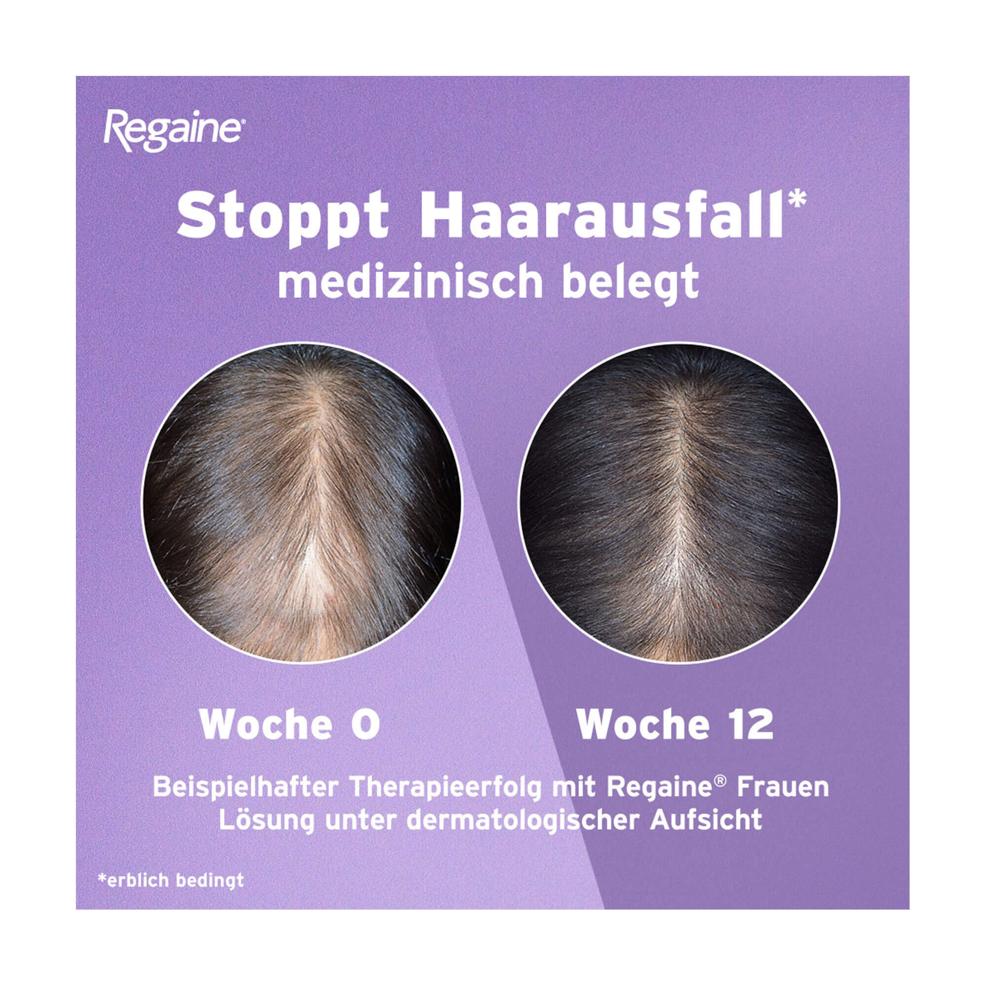 Grafik Regaine Frauen Lösung Vorher-Nachher-Vergleich